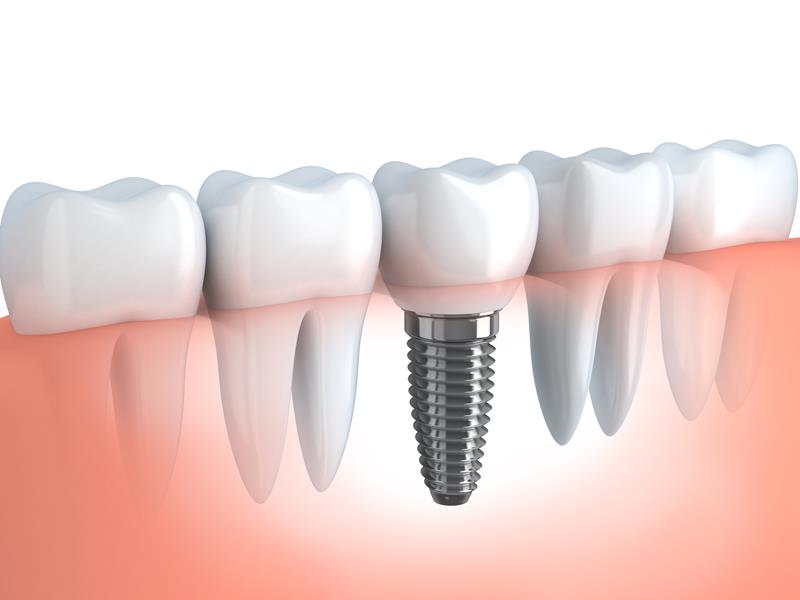 Dental Implants  New York City, NY